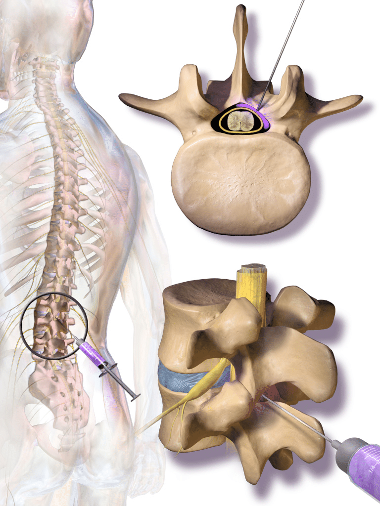 Epidural Steroid Injection Console And Associates P C technique-to-do-transforaminal-epidural-steroid-injection-tfesi-under