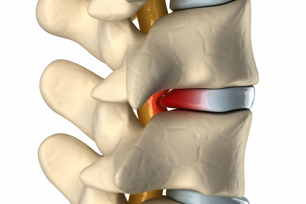 Bulging Disc Settlements