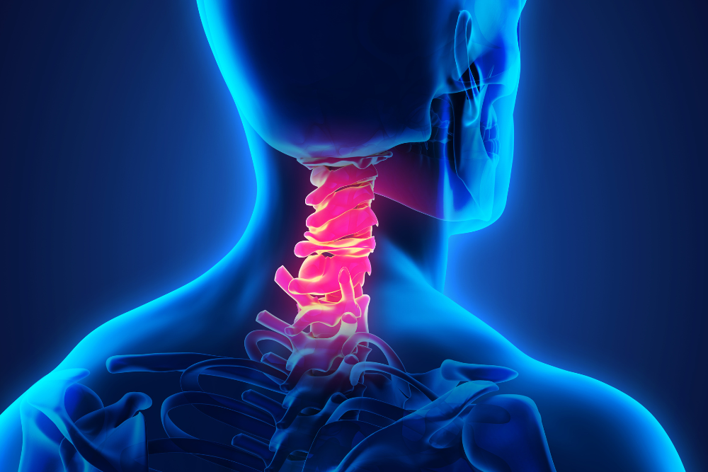 Cervical Herniation Settlements