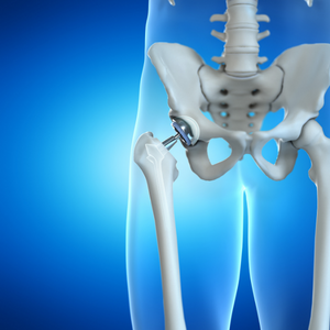 Metal-on-Metal Hip Implant